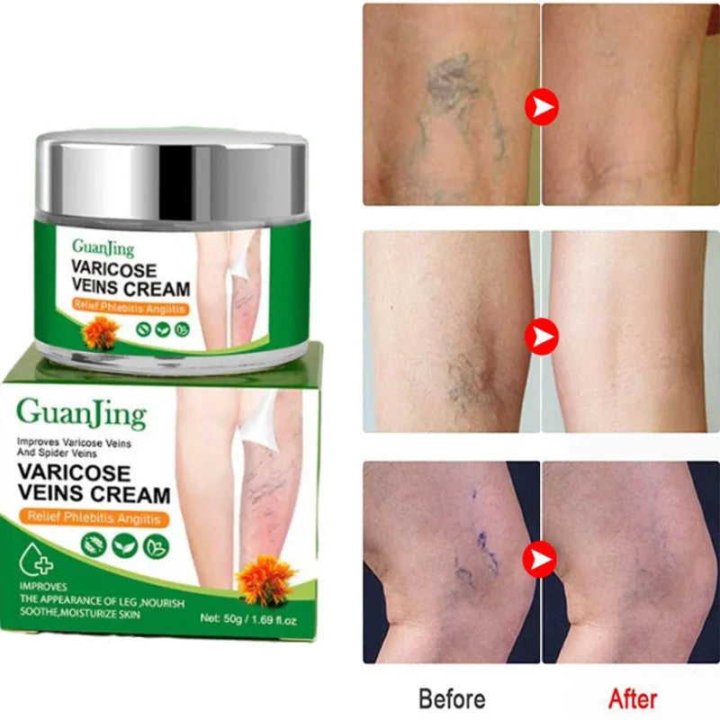 GuanJing Varicose Veins Cream - Resultados antes y después